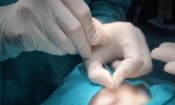 Çukurca'da gözyaşı kanalı ameliyatları yapılmaya başlandı