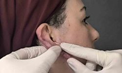 Muş'ta bir ilk: Kulak keloidi, ödüllü cerrahi teknikle tedavi edildi