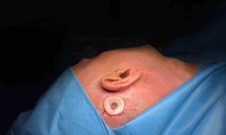 Balıkesir'de ilk kemiğe implante işitme cihazı ameliyatı yapıldı