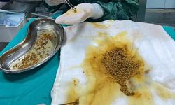 Bingöl'de nadir vaka: Safra kesesinden 2 bin 67 taş çıkarıldı