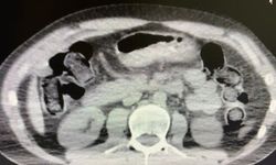 Midelerinde uyuşturucu sevkiyatı yapan 2 torbacı tutuklandı