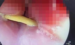 Boğazına saplanan 5 santimlik kemik öldürüyordu