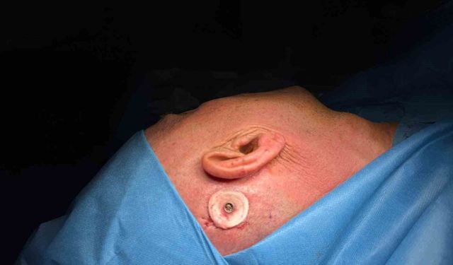 Balıkesir'de ilk kemiğe implante işitme cihazı ameliyatı yapıldı