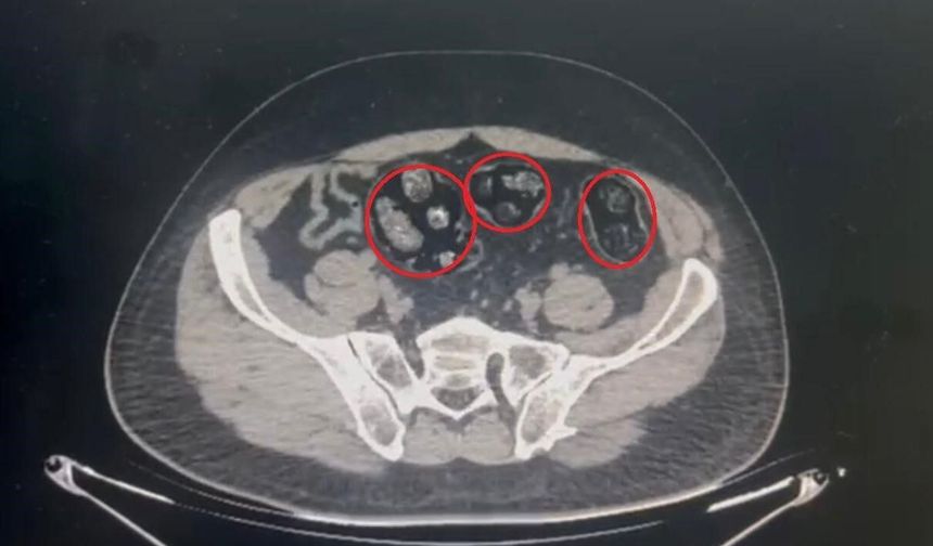 Yolcunun midesinden 62 parça uyuşturucu çıktı